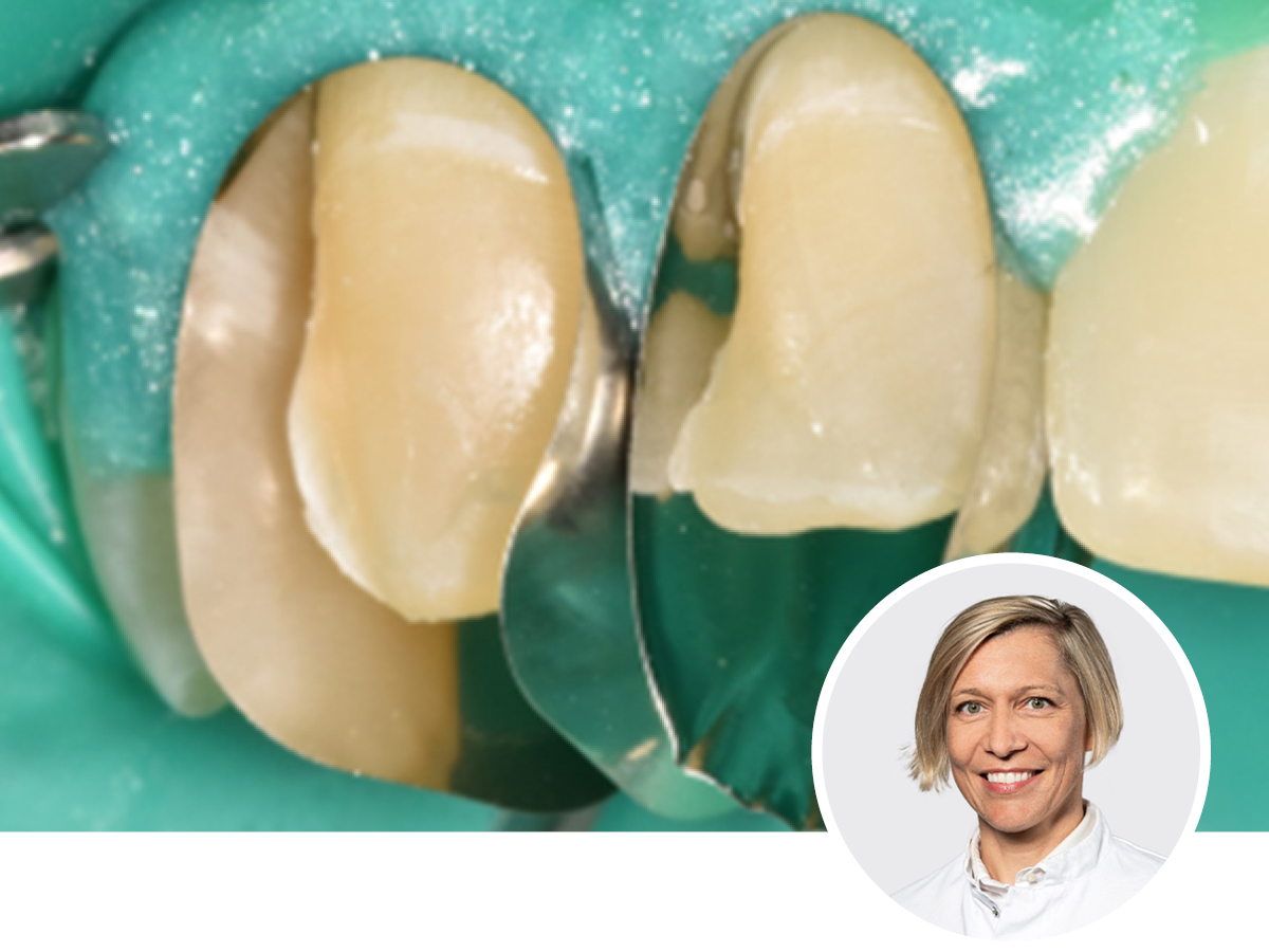 Next Level Frontzahnaufbau: direktes Veneer, Eckenaufbau, Zahnhalsfüllung | 10.06.2026