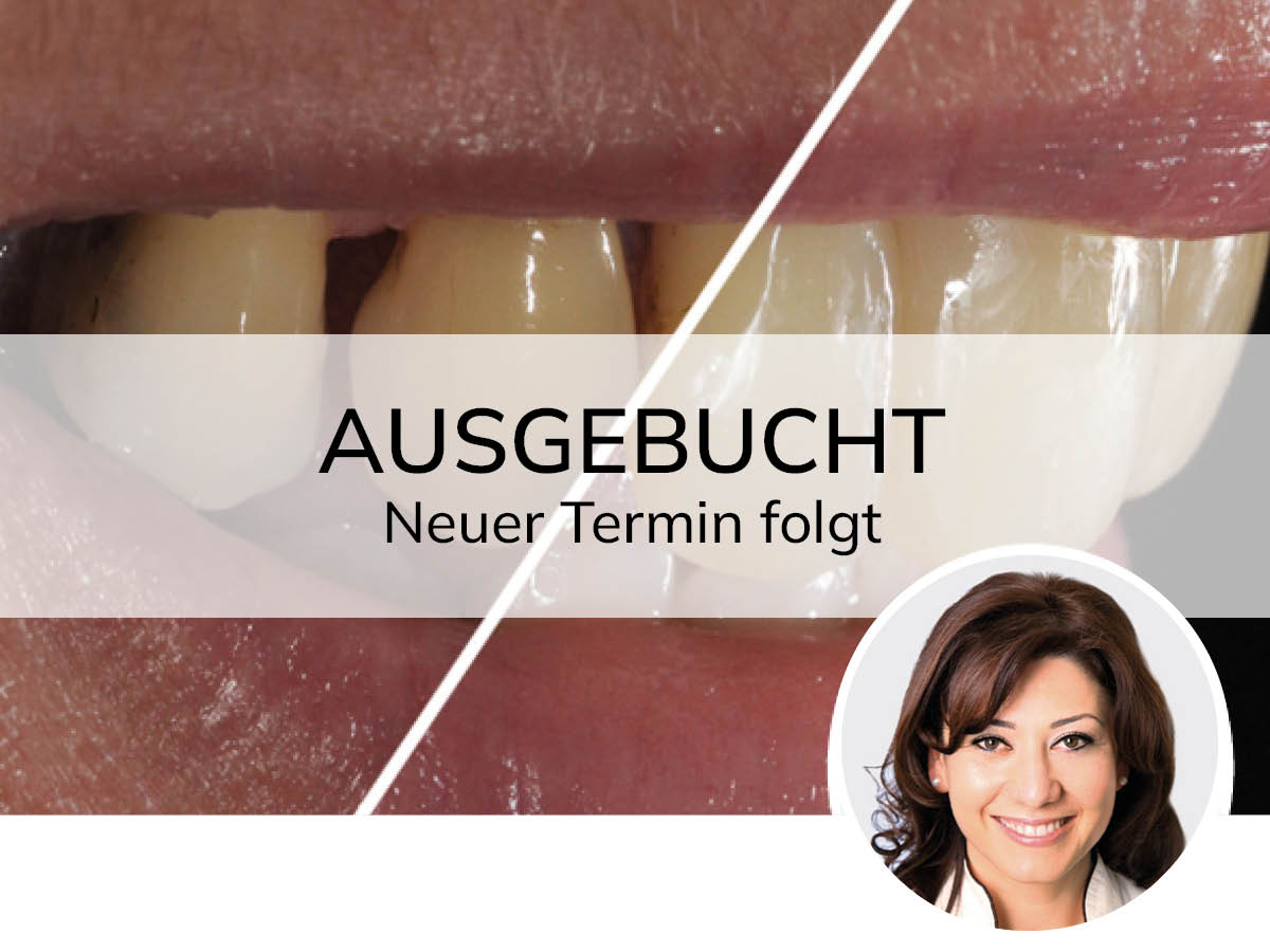 Hochästhetisches, nichtinvasives Komposit-Veneering | 12. - 13.09.2025 | Köln