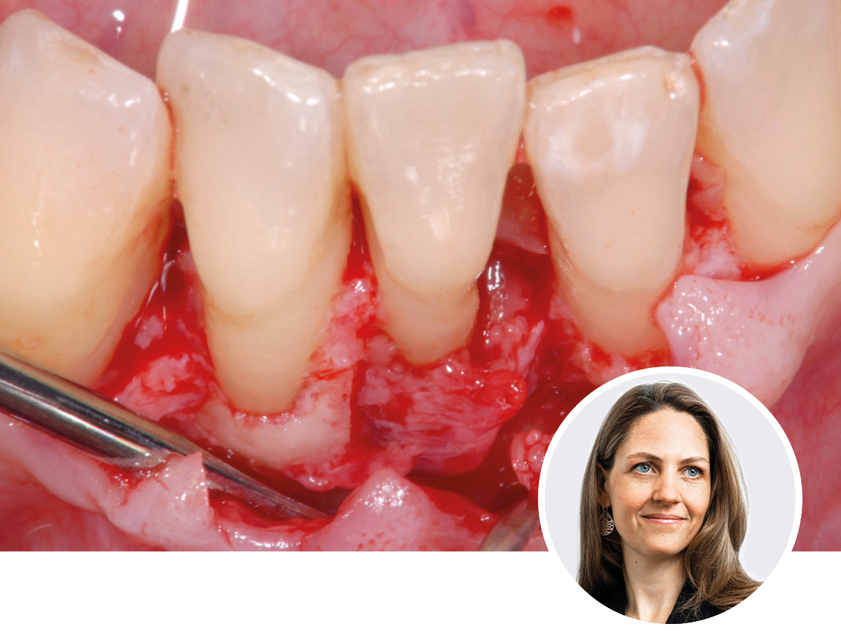 Regenerative Parodontitis-Therapie - Möglichkeiten und Limitationen | 18.04.2026 | München