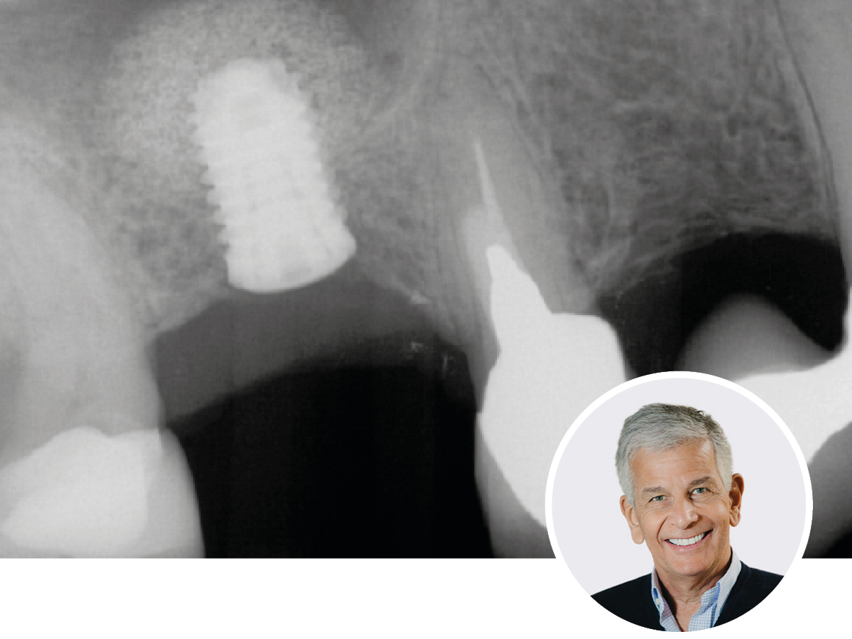 Osseodensification und Augmentation aus einer Hand | 28.11.2025  | Wien