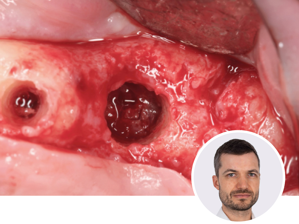 Osseodensification - Optimieren Sie Ihre Implantat-Präparation | 10.10.2026 | Köln