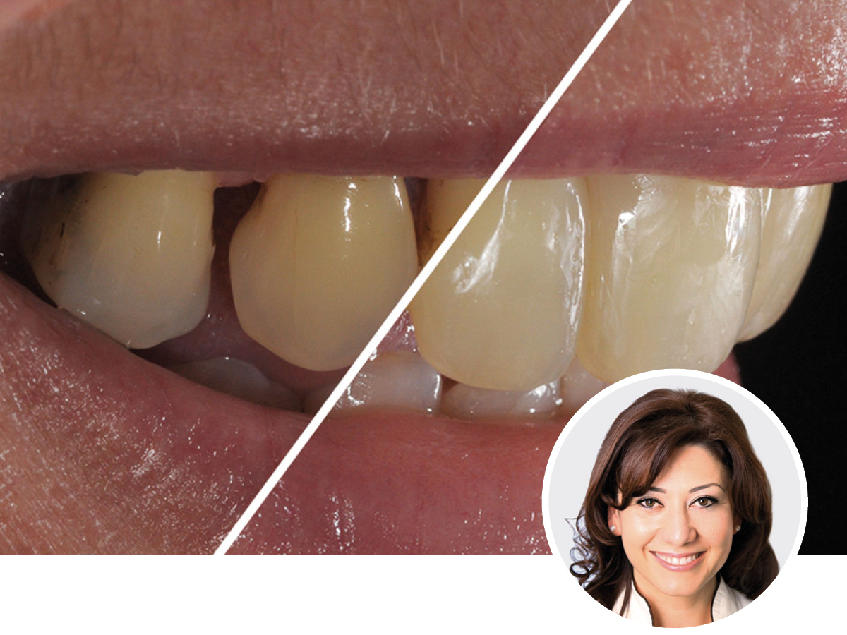 Hochästhetisches, nichtinvasives Komposit-Veneering | 15 - 16.05.2026 | München