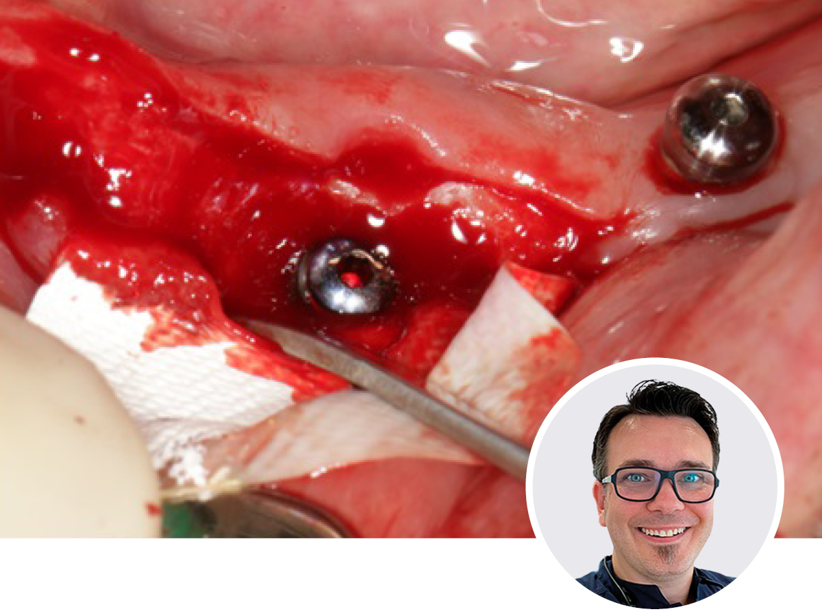 Optimierte Implantologie - einfaches Knochenmanagement für jede Situation | 05.11.2025