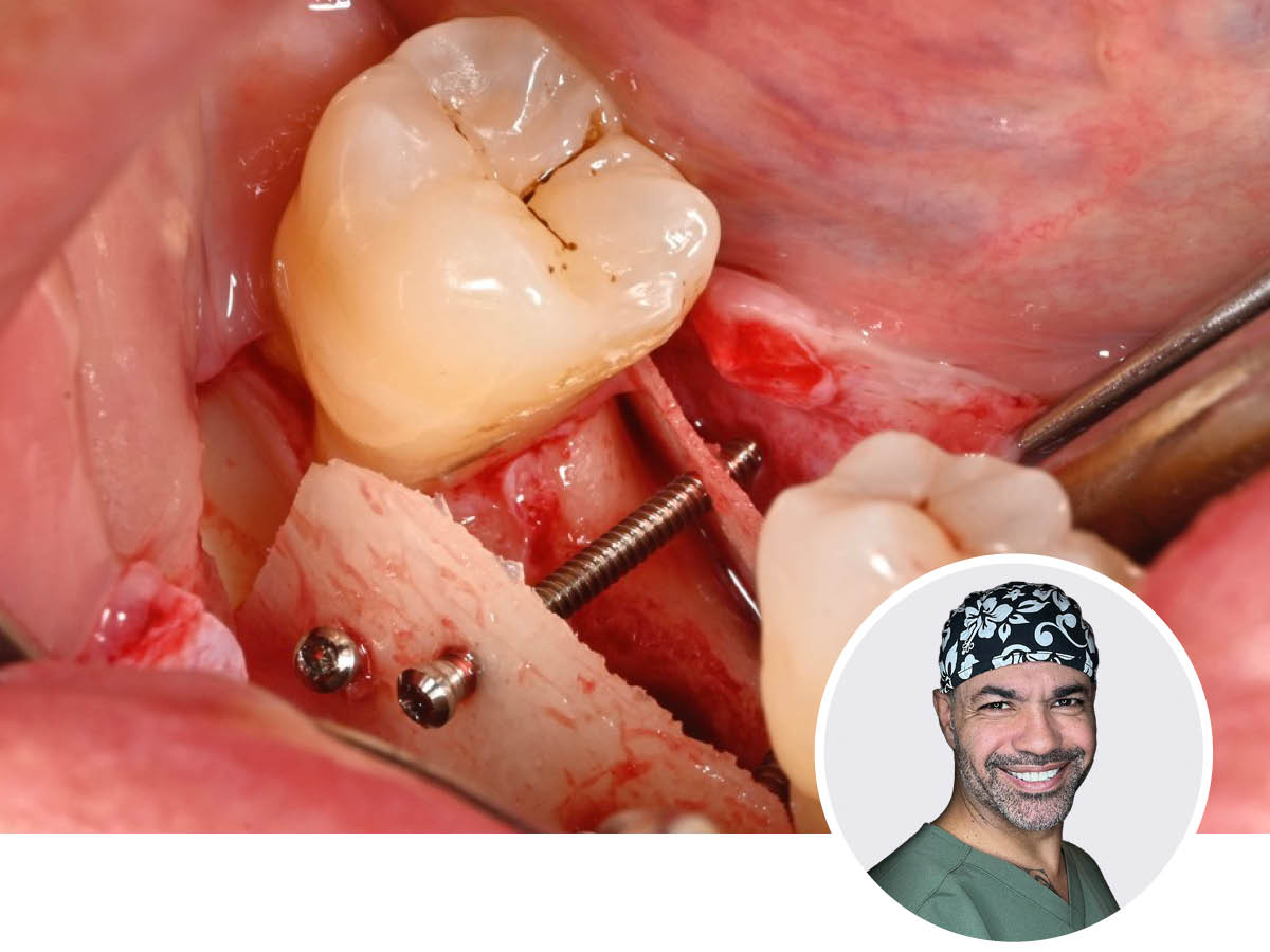 Großvolumige Knochenaugmentation | 13. - 14.11.2026 | Köln