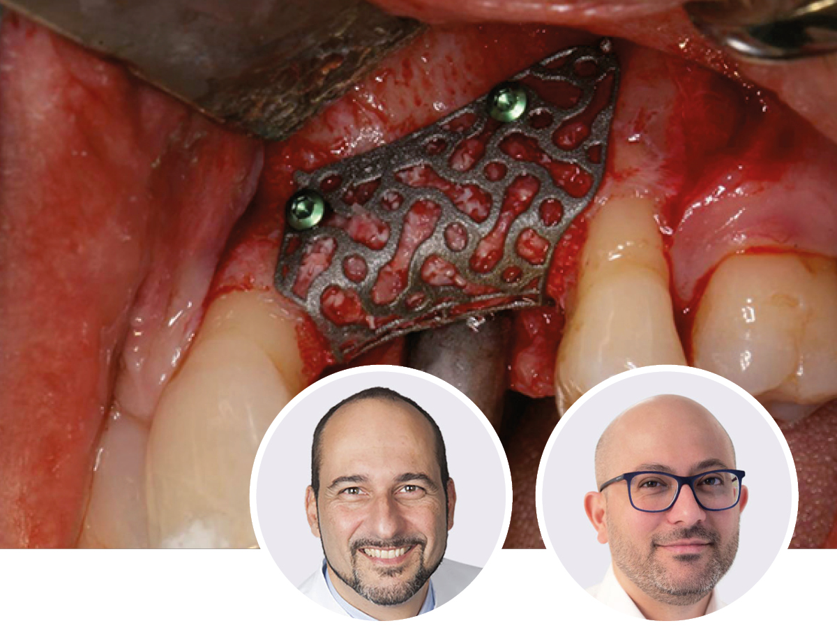 Das Mainzer Augmentationskonzept: Techniken für den implantologischen Alltag | 09. - 10.10.2026 | München