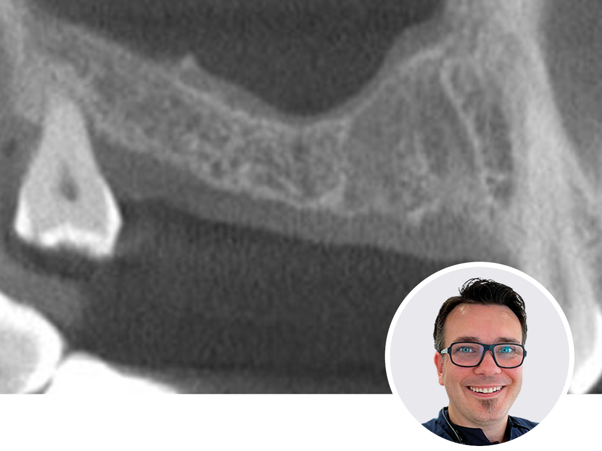 Optimierte Implantologie - Knochenmanagement für jede Situation | 06.12.2025  | Hannover