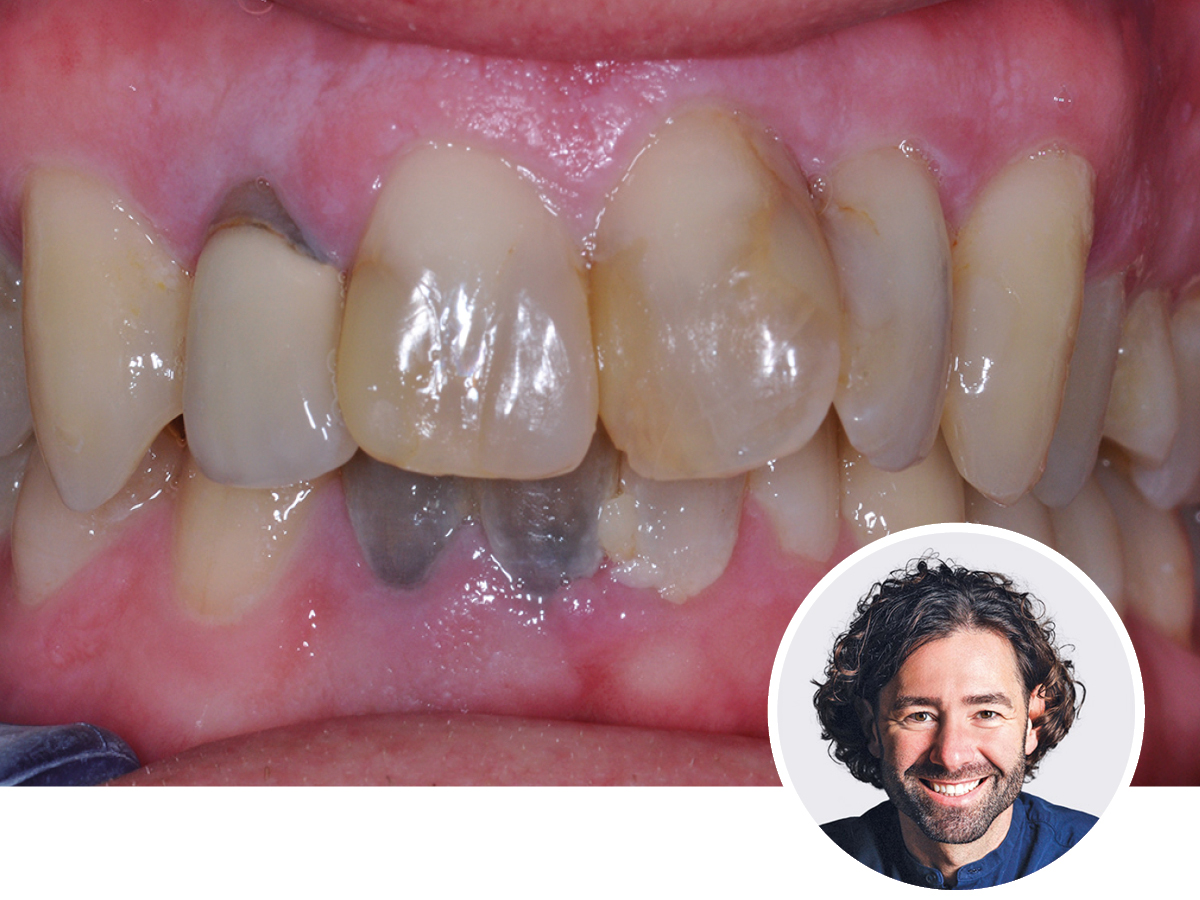 Vom kleinen Eckenaufbau bis zur Composite-Krone |  19. - 20.06.2026 | Hamburg