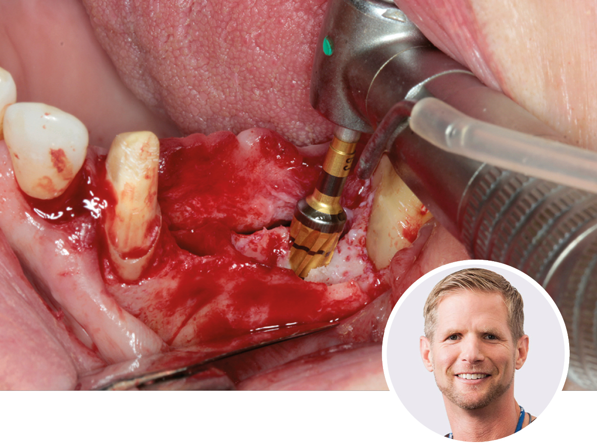 Modernes Knochenmanagement: Osseodensifikation & Augmentation | 20.06.2026 | Hamburg